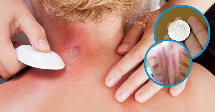 Cạo gió có tốt không? Những vấn đề xoay quanh việc cạo gió