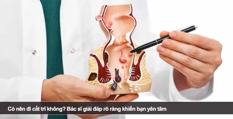 Có nên đi cắt trĩ không? Bác sĩ giải đáp rõ ràng khiến bạn yên tâm