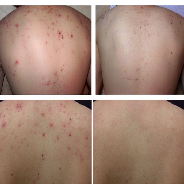 Top 10 Spa trị mụn lưng uy tín & hiệu quả tại TPHCM