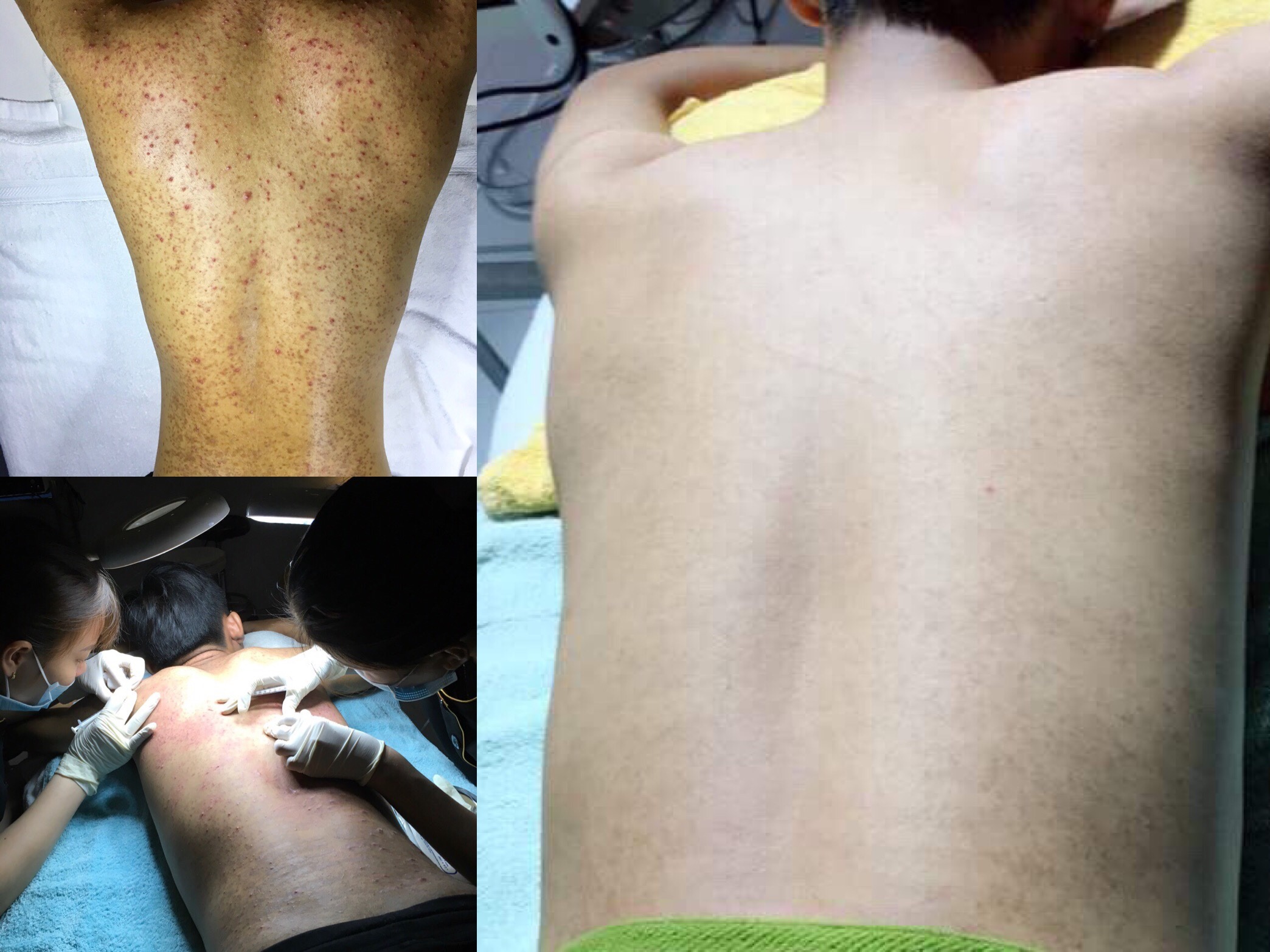 Top 10 Spa trị mụn lưng uy tín & hiệu quả tại TPHCM