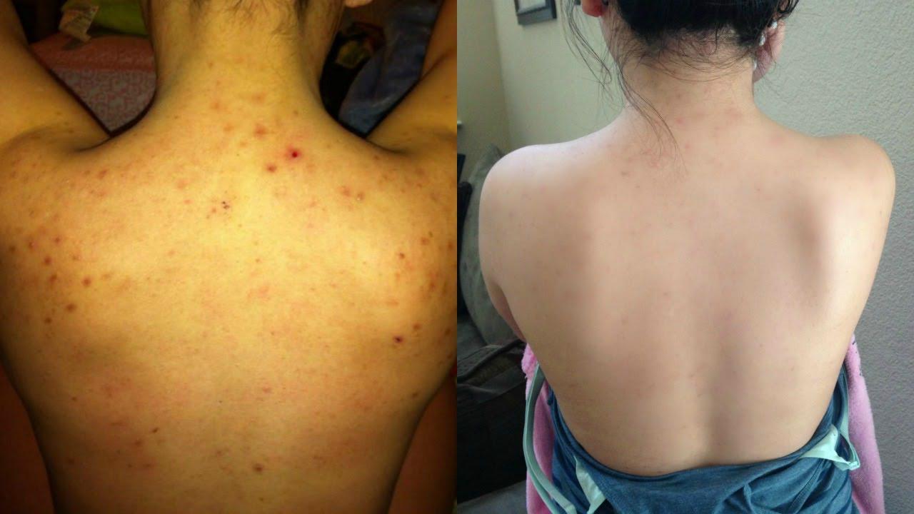 Top 10 Spa trị mụn lưng uy tín & hiệu quả tại TPHCM