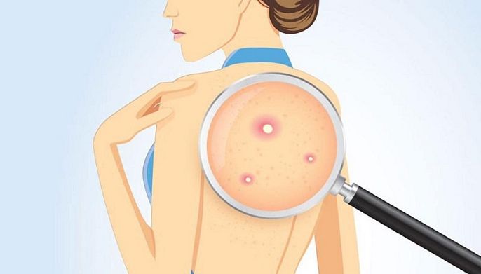 Top 10 Spa trị mụn lưng uy tín & hiệu quả tại TPHCM