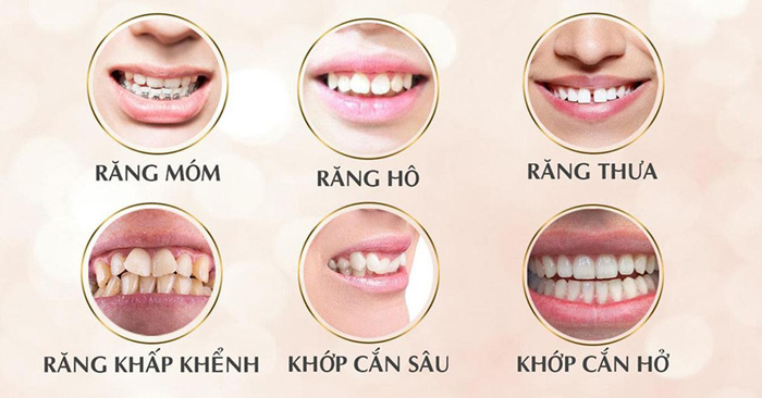 Niềng răng ở đâu tốt nhất TPHCM? Xem top địa chỉ uy tín