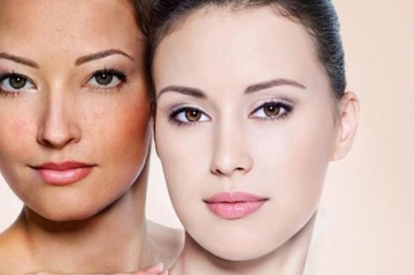 Review dịch vụ giảm nám da tại Gò Vấp của Lê Thủy Spa
