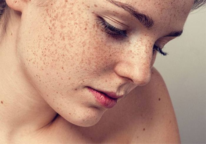 Review dịch vụ giảm nám da tại Gò Vấp của Lê Thủy Spa