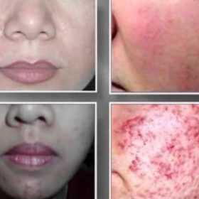 Những Dấu Hiệu Da Nhiễm Corticoid Cần Phải Đặc Biệt Chú Ý