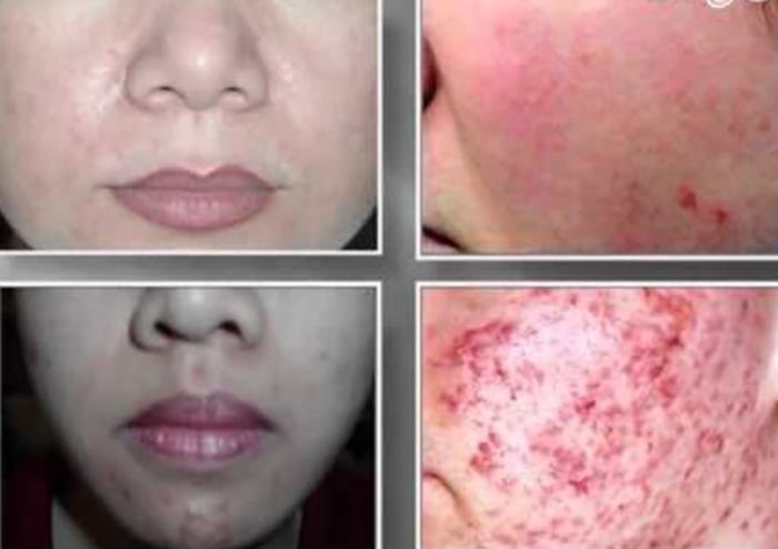 Những Dấu Hiệu Da Nhiễm Corticoid Cần Phải Đặc Biệt Chú Ý