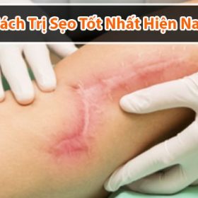 Tham khảo cách trị sẹo lồi tốt nhất dành cho bạn hiện nay