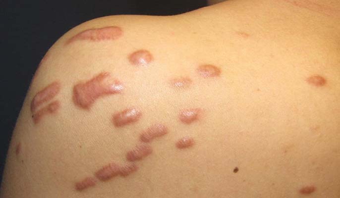 Tham khảo cách trị sẹo lồi tốt nhất dành cho bạn hiện nay