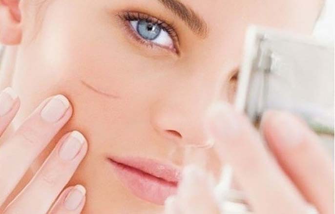 Tham khảo cách trị sẹo lồi tốt nhất dành cho bạn hiện nay