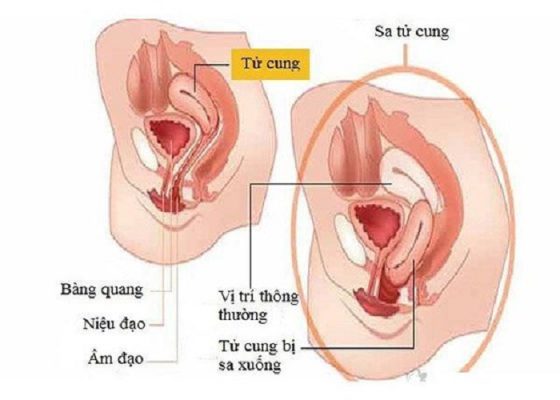 Hướng dẫn 5 bài tập chữa sa tử cung ngay tại nhà