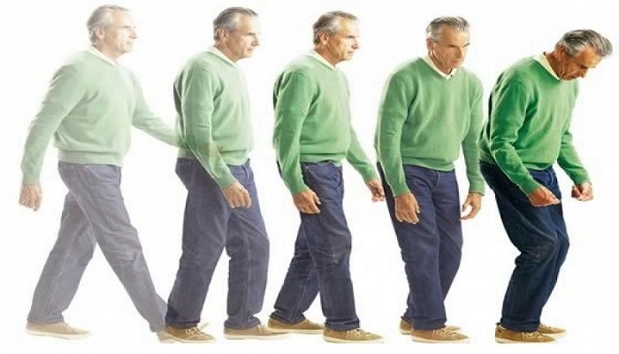 Biến chứng bệnh parkinson là gì? Có nguy hiểm không?