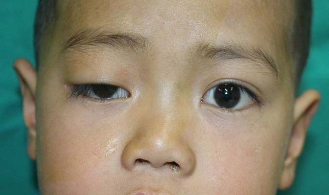 Địa chỉ phẫu thuật thẩm mỹ mắt to mắt nhỏ uy tín tại Sài Gòn
