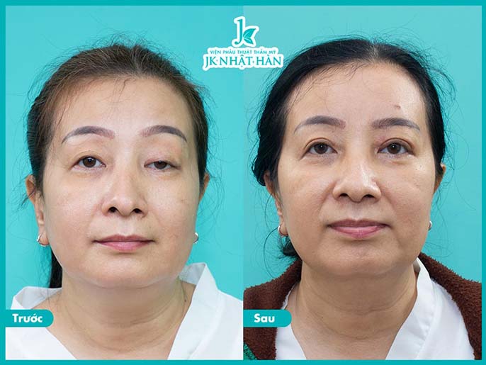 Địa chỉ phẫu thuật thẩm mỹ mắt to mắt nhỏ uy tín tại Sài Gòn