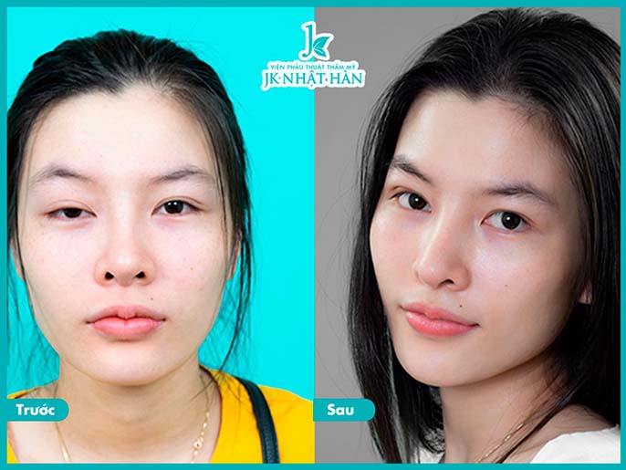 Địa chỉ phẫu thuật thẩm mỹ mắt to mắt nhỏ uy tín tại Sài Gòn