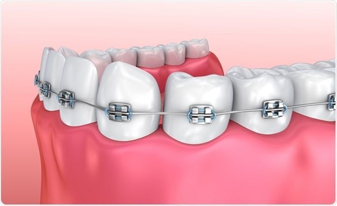 Top 5 địa chỉ niềng răng uy tín ở Đà Nẵng