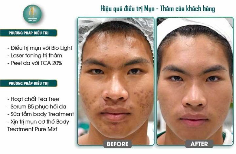 Thẩm mỹ viện Anchee - Trung tâm điều trị thâm mụn hiệu quả tại TP HCM