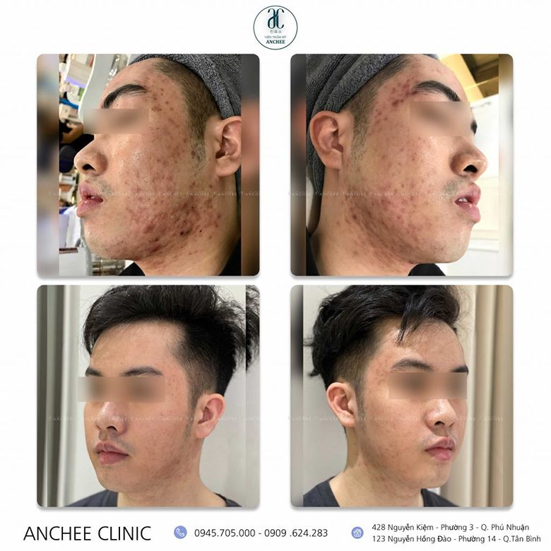 Thẩm mỹ viện Anchee - Trung tâm điều trị thâm mụn hiệu quả tại TP HCM