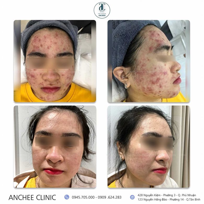 Thẩm mỹ viện Anchee - Trung tâm điều trị thâm mụn hiệu quả tại TP HCM