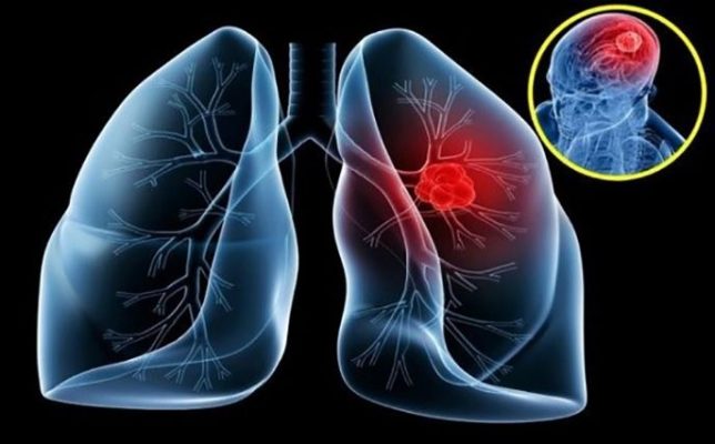 Thuốc đích điều trị ung thư phổi thế hệ thứ 3
