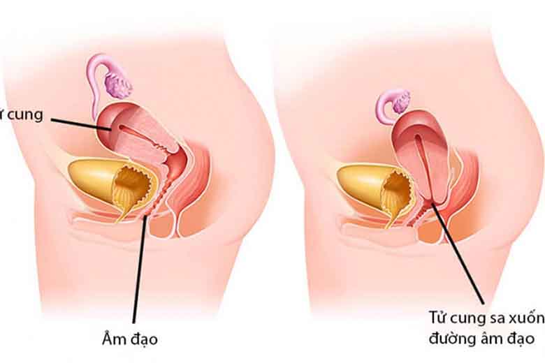 Sản phẩm nào chữa sa tử cung tốt nhất hiện nay?
