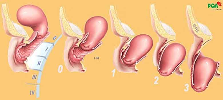 Sản phẩm nào chữa sa tử cung tốt nhất hiện nay?
