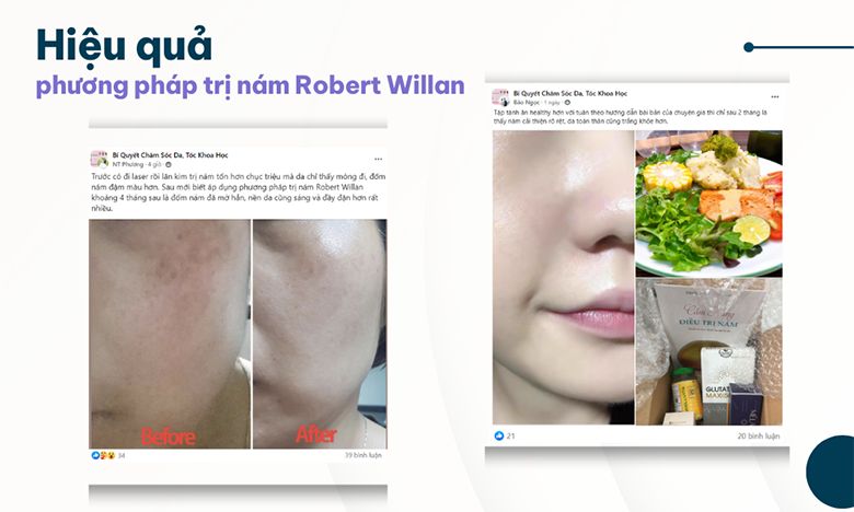 Chuyên gia da liễu khuyên dùng phương pháp trị nám Robert Willan