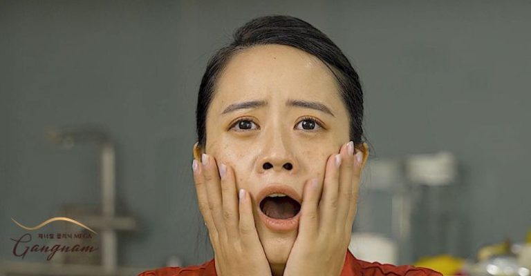 Trị nám sau sinh tại Mega Gangnam
