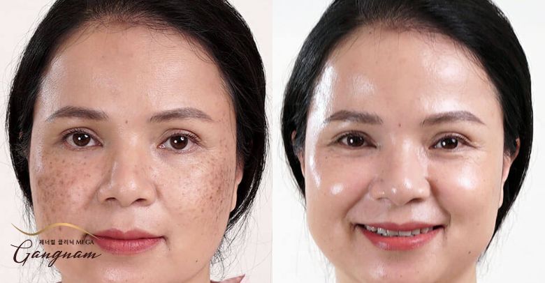 Trị nám sau sinh tại Mega Gangnam