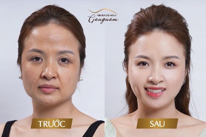 Các phương pháp căng da mặt được lựa chọn hiện nay