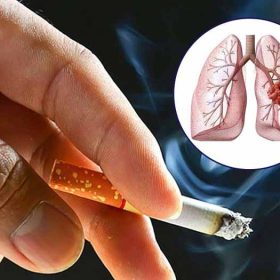 Những nguyên nhân gây bệnh ung thư phổi thường gặp nhất