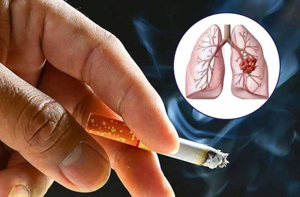 Những nguyên nhân gây bệnh ung thư phổi thường gặp nhất