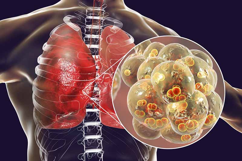 Những nguyên nhân gây bệnh ung thư phổi thường gặp nhất